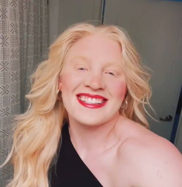 Mya Lynn Lesnar, Brock Lesnar Daughter Age, Albinism, Now