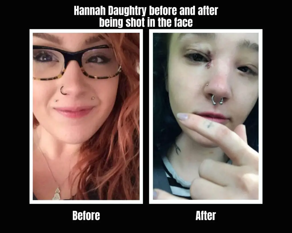 Hannah Daughtry before and after being shot in the face